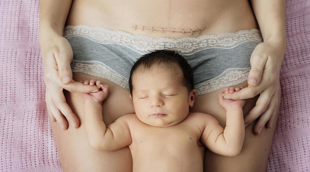 9 Myths about C-Section that Need to Be Busted!